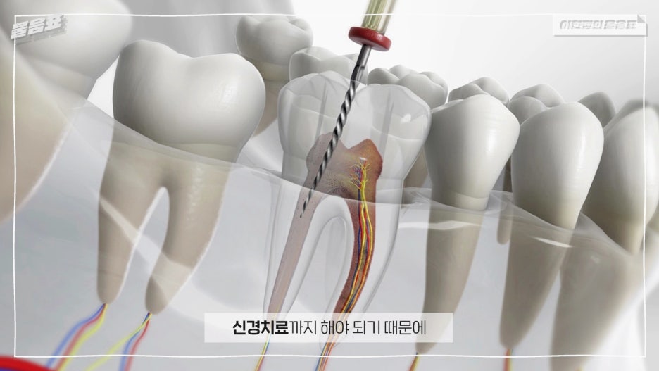 치아의 검은점 충치? 원인과 치료법! 아름드리치과 관련 이미지 14