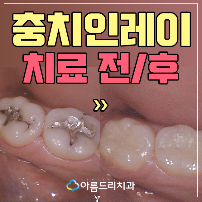 충치인레이 아말감주변 충치치료는? 관련 이미지 1