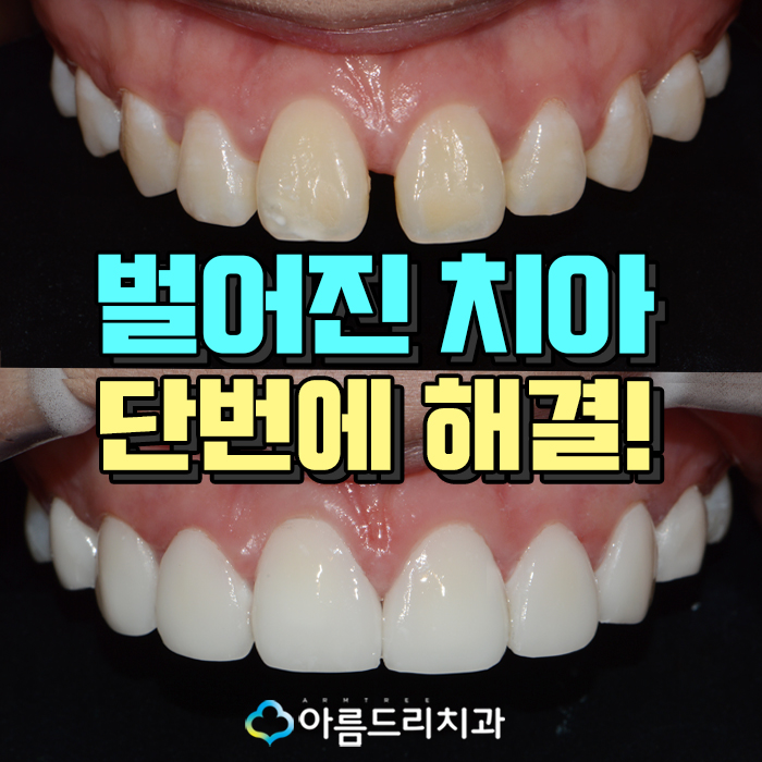 벌어진앞니 앞니라미네이트 치료후기 관련 이미지 1