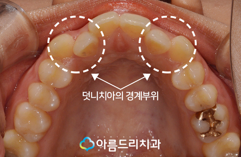 덧니부분교정 앞니 이런후기만 관련 이미지 6