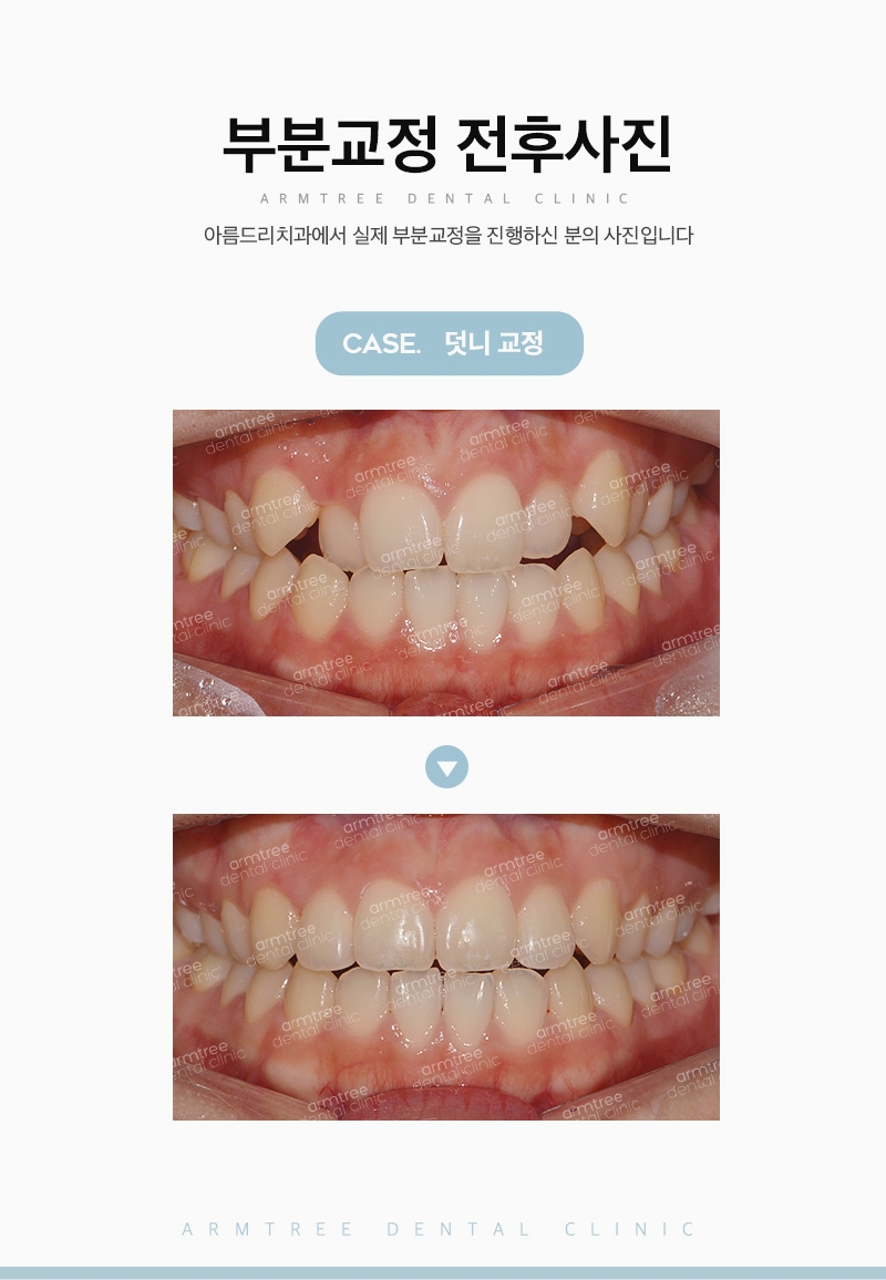 덧니부분교정 아름드리치과에서 확실하게 관련 이미지 11
