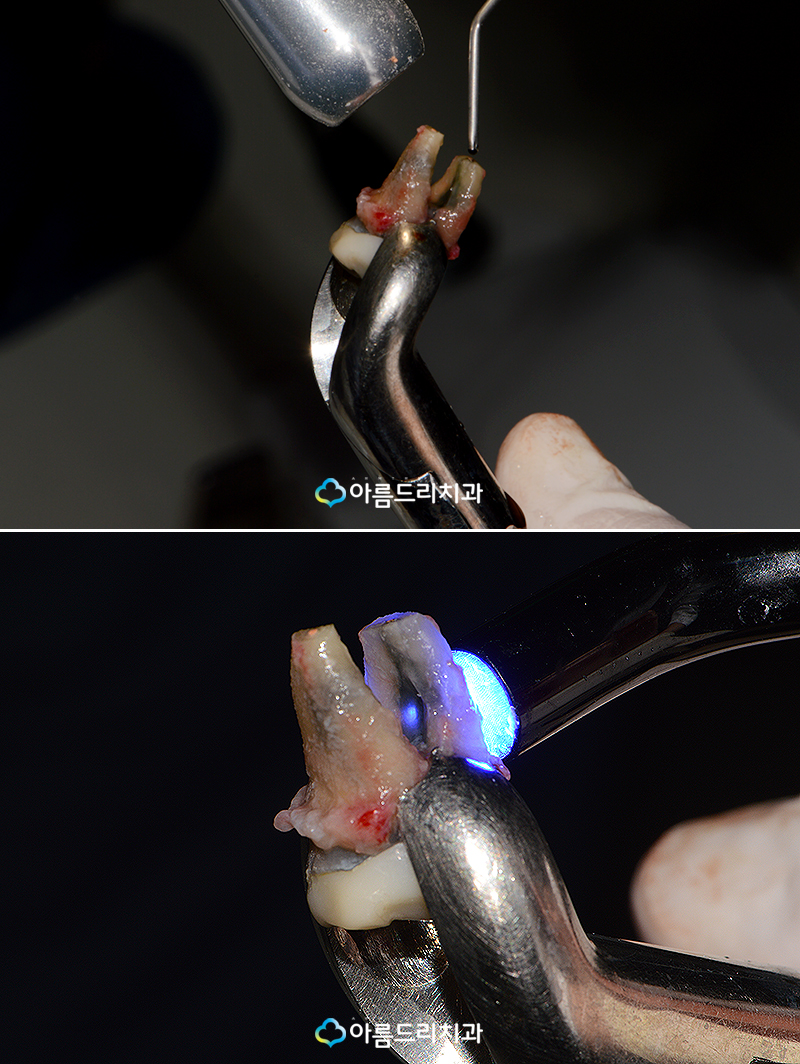 치아재식술 치료후기 자연치아살리기 관련 이미지 7