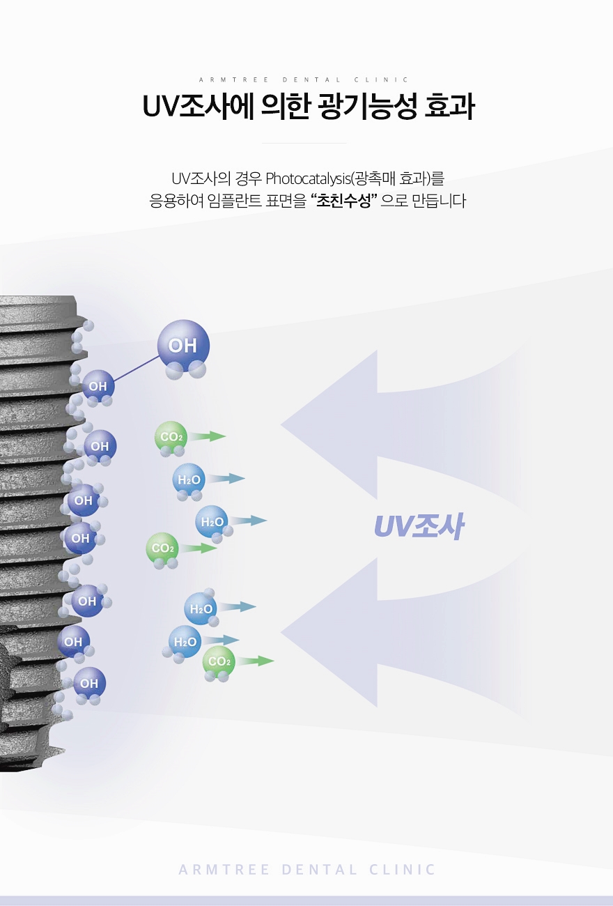 UV임플란트 꼼꼼히 따져보면 관련 이미지 5