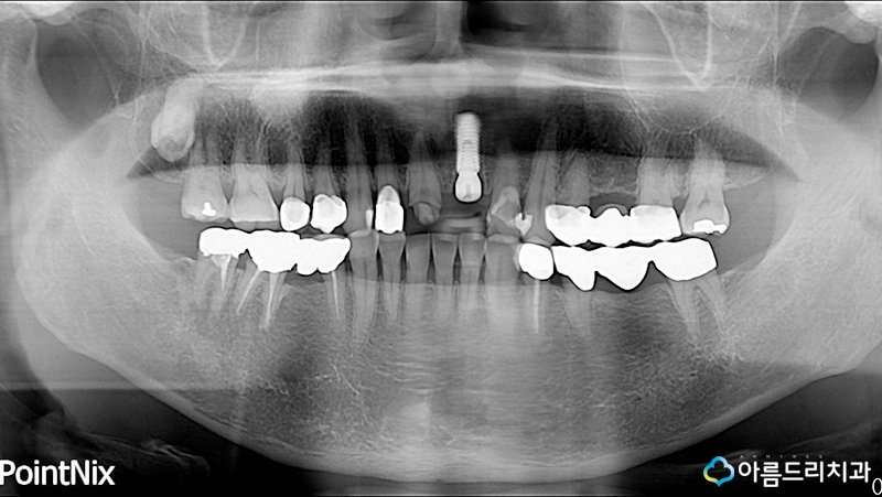 치아탈구(깨짐) 앞니임플란트 지르코니아어버트먼트 관련 이미지 7