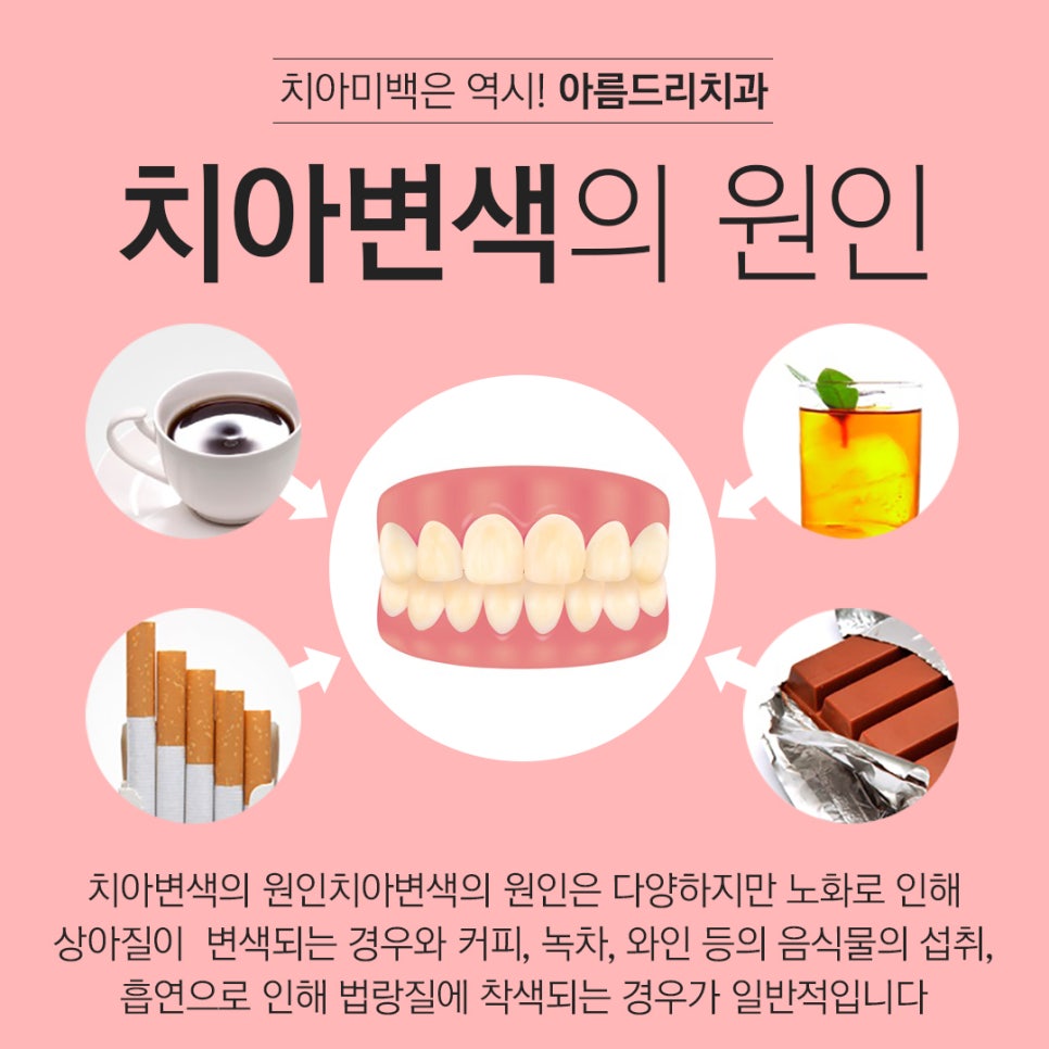 치과 치아미백 후기 궁금하다면 관련 이미지 2