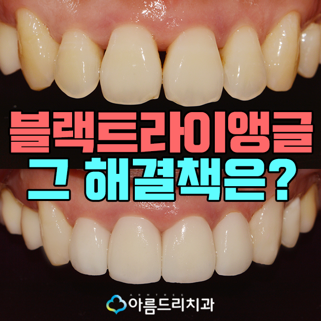 앞니블랙트라이앵글 치료 치아 후기 관련 이미지 1