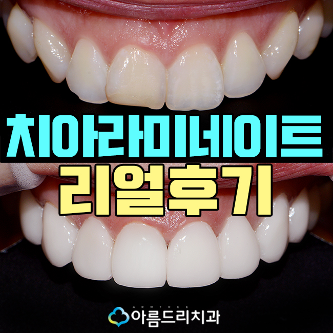 치아라미네이트 삭제량이 초중요 관련 이미지 1