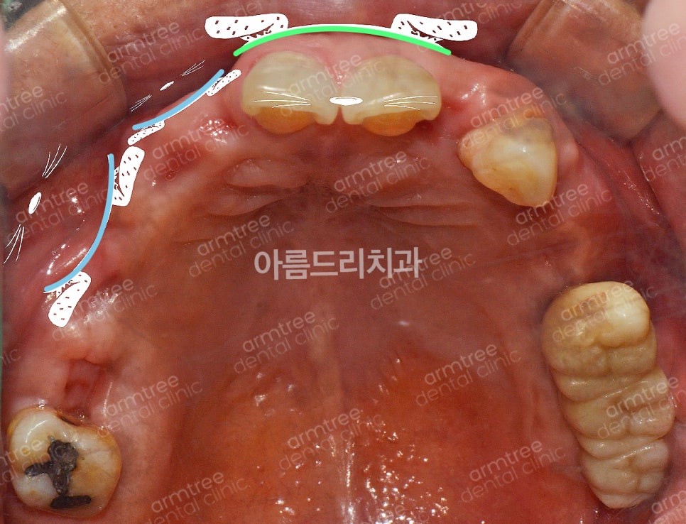 임플란트 심미보철 전후 아름드리치과 진료일기 관련 이미지 3