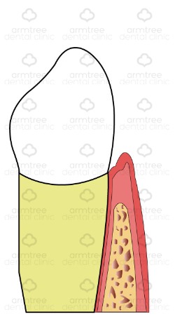 [치주 질환-1] 양치할 때마다 피가 난다?(아름드리 치아상식) 관련 이미지 2