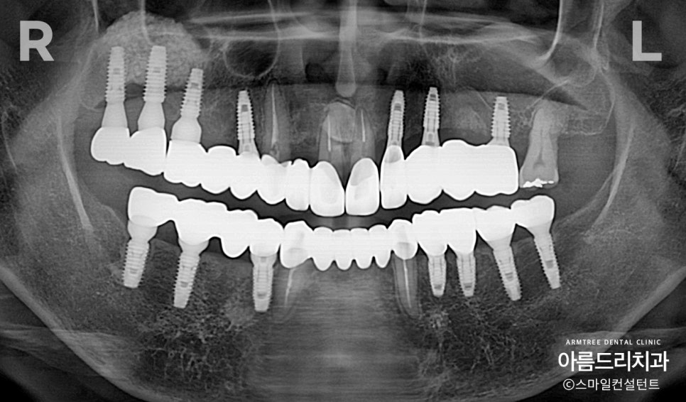임플란트 심미보철 전후 아름드리치과 진료일기 관련 이미지 9