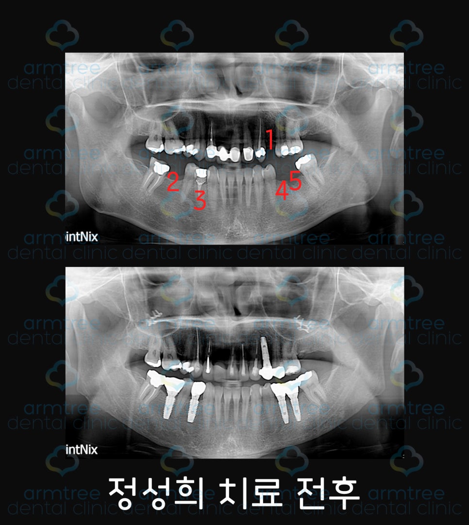 이현정 원장의 아름다운 당신 시즌 1 (8회 정성희 도전자) 임플란트, 신경치료, 치아성형, 올세라믹, 치아미백, 화이트랩스 관련 이미지 2