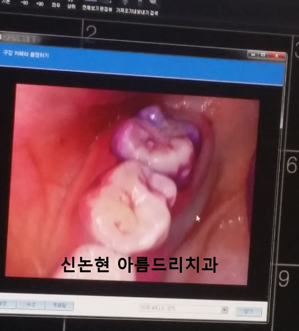 [신논현치과]어린이양치교육_구강검진_유아충치_충치예방 관련 이미지 8