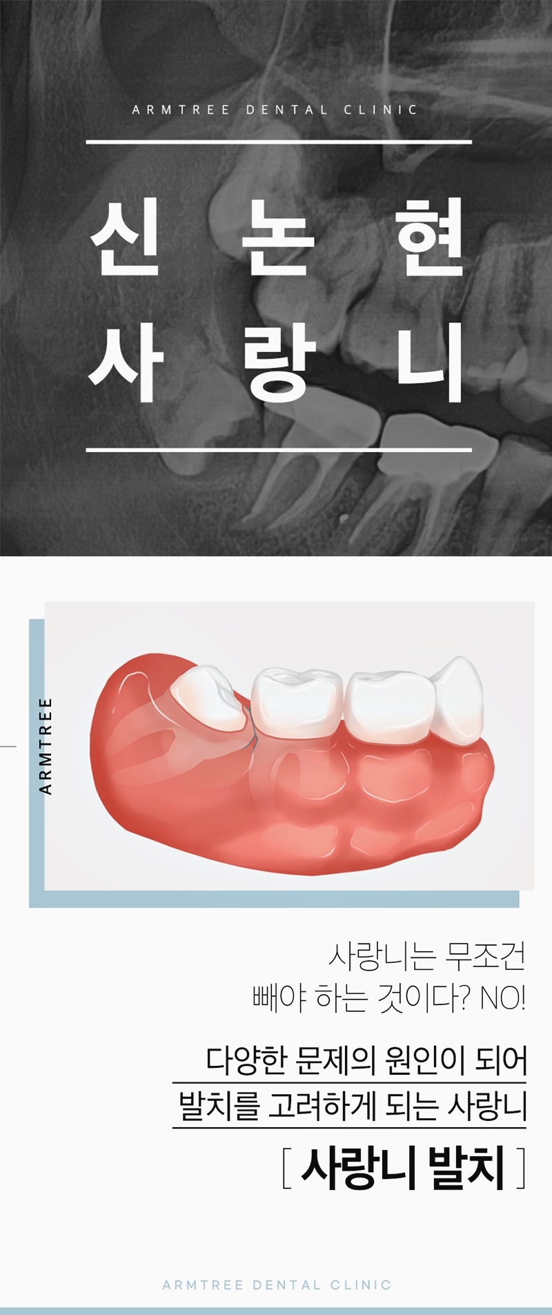 신논현역 사랑니발치를 원하고 있다면 관련 이미지 1
