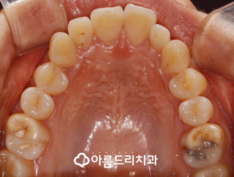 급속치아교정 코티코토미 피질골절단술 후기 관련 이미지 5