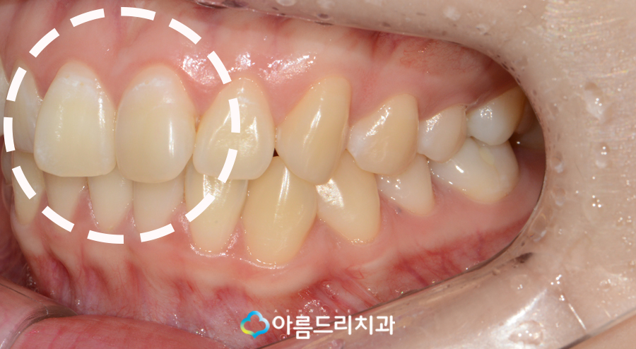 나비치아 교정 앞니 부분교정 후기 관련 이미지 5