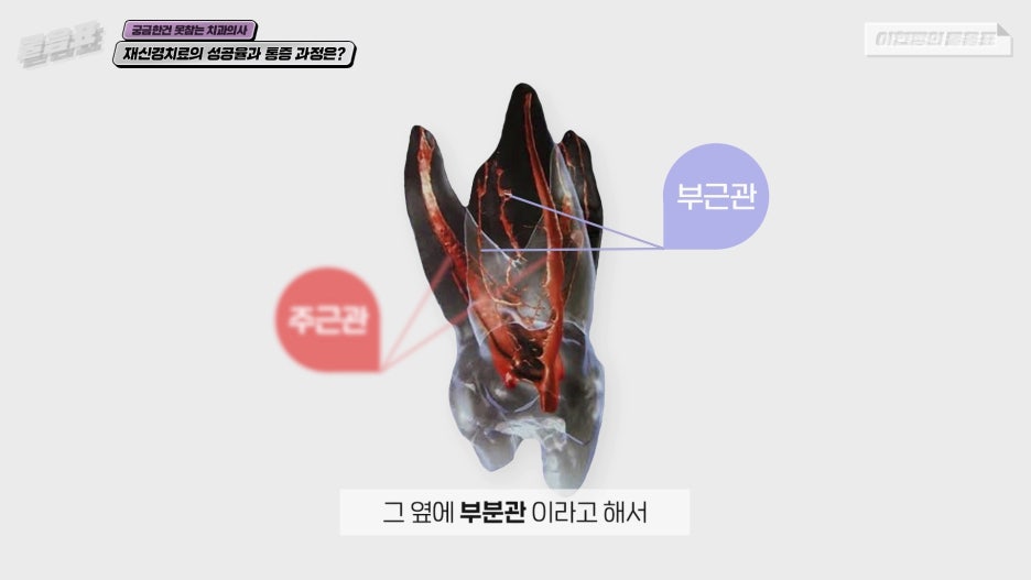 치아 재신경치료 성공율 과정과 통증 #이현정의물음표 관련 이미지 4