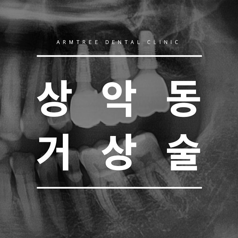 신논현역치과 상악동거상술을 원한다면 관련 이미지 1