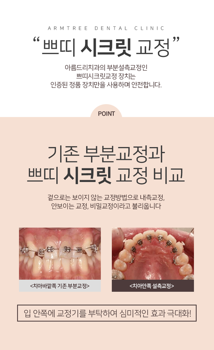 설측교정 후기앞니 단기간에 관련 이미지 6