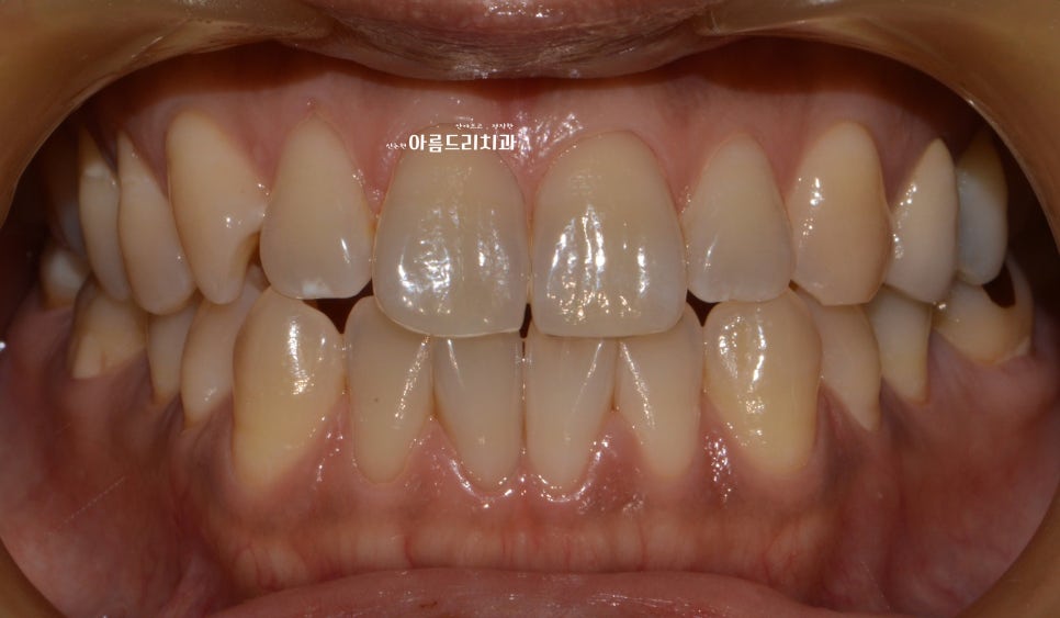 치아미백 효과부터 그 후 모든 것_치과 미백_자가미백 관련 이미지 4