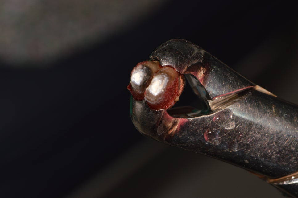 [신논현 치과] 임플란트 대신 치아재식(아름드리치과) 관련 이미지 9