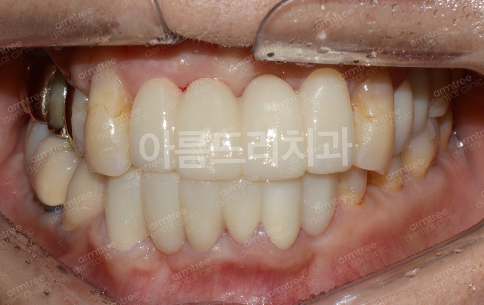 임플란트가 무조건 최선은 아니다! 아름드리치과 진료일기 관련 이미지 10