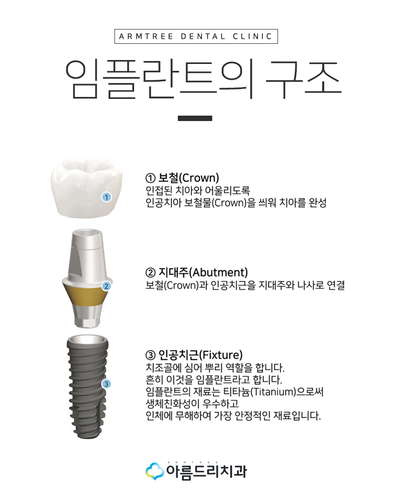 임플란트 구멍(홀)이 났는데 어떻하죠? 관련 이미지 5