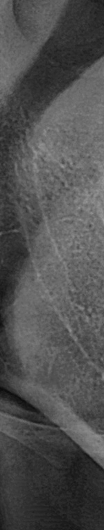 반포치과 사랑니발치 치과를 찾고있다면 관련 이미지 5