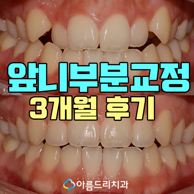 앞니부분교정 후기 덧니 걱정NO! 관련 이미지 1