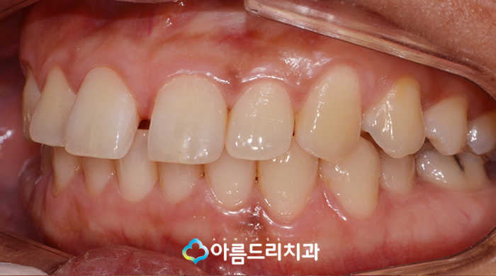 부분치아교정 앞니벌어짐 부분교정후기는! 관련 이미지 4