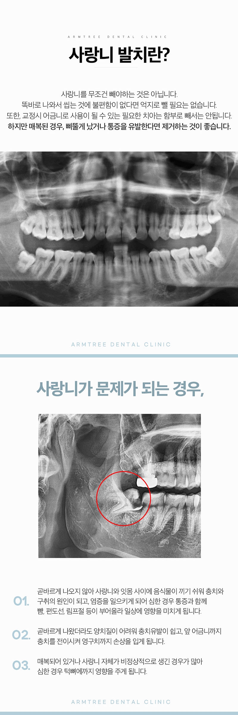 신논현치과 사랑니발치 치과는 신중하게 관련 이미지 2