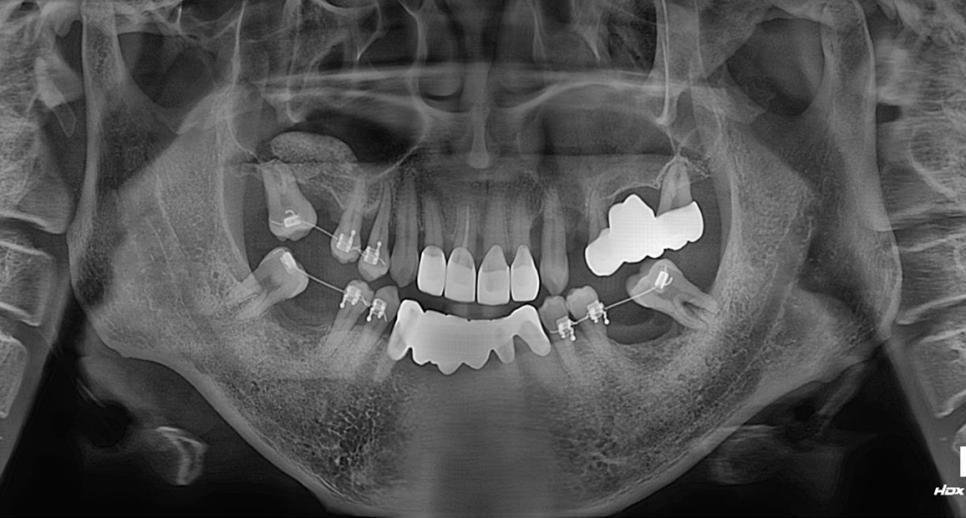 치아를 최대한 보존하는 임플란트 치료 관련 이미지 2