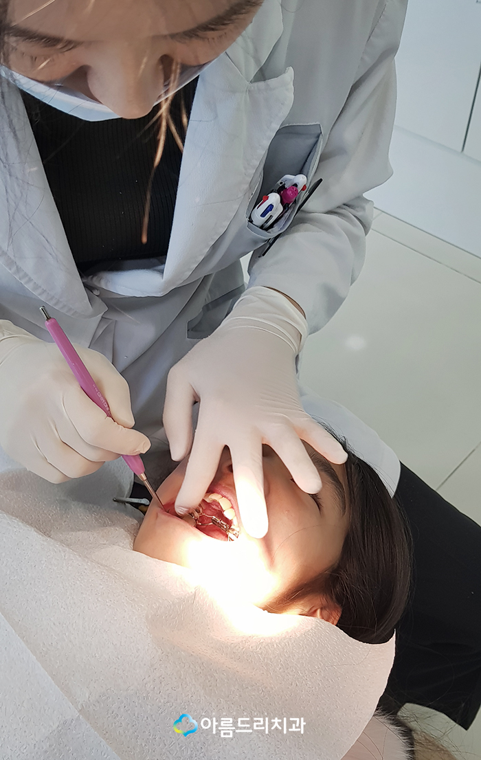 어린이 부정교합교정 RPE 악궁확장장치 관련 이미지 5