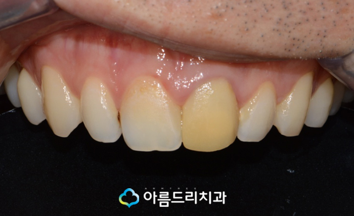 앞니 임시치아 전치부 크라운 재치료 관련 이미지 2