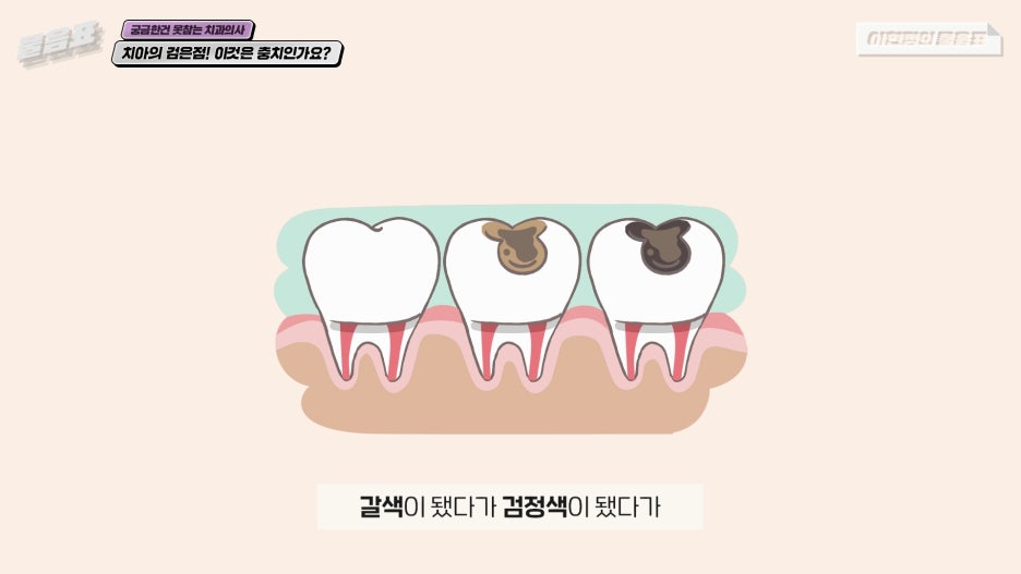 치아의 검은점 충치? 원인과 치료법! 아름드리치과 관련 이미지 3