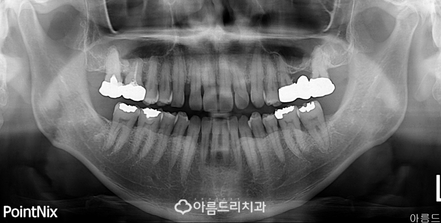 라미네이트교정 최소삭제 치아성형 후기 관련 이미지 3