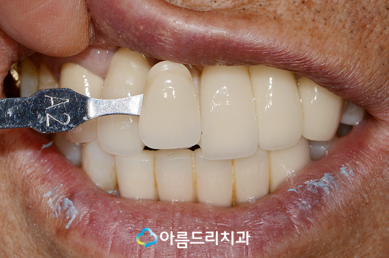 앞니 브릿지가 깨졌어요 치과치료 관련 이미지 8
