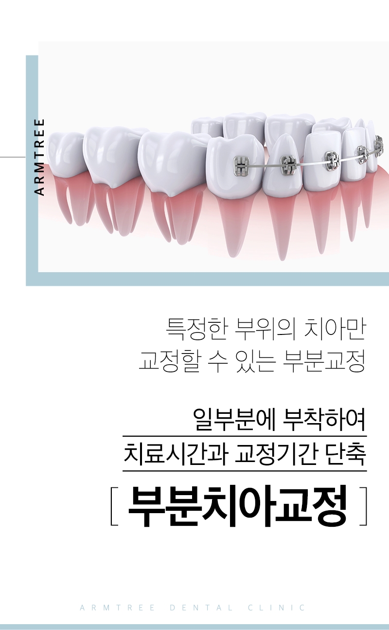 입툭튀교정 돌출앞니부분교정 후기는 아름드리치과 관련 이미지 2