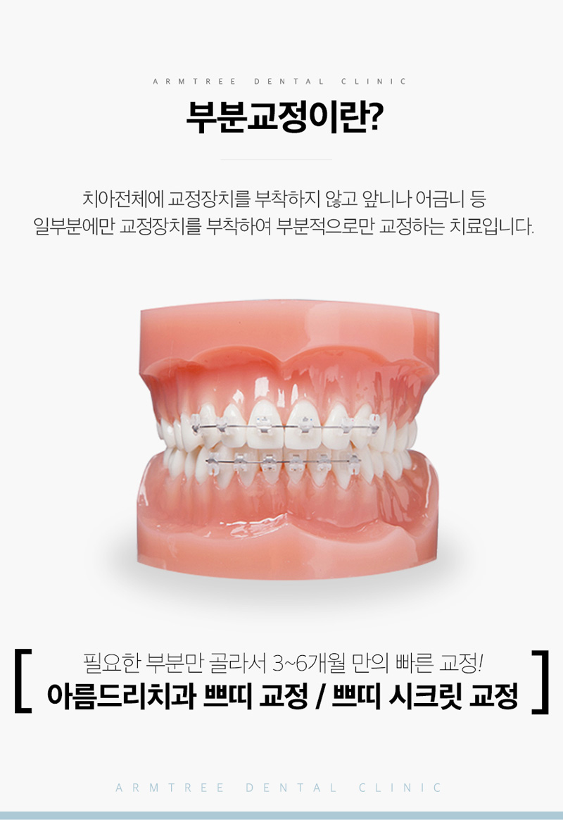 부분교정기간 부담된다면 단기간에 아름드리치과 관련 이미지 4