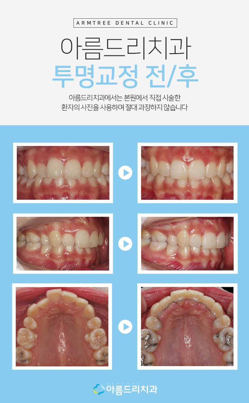 투명치아교정 투명교정기 장단점 관련 이미지 6