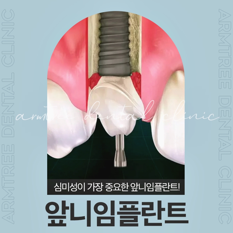 신논현역 앞니임플란트 미용적인 부분까지 고려해야 관련 이미지 1
