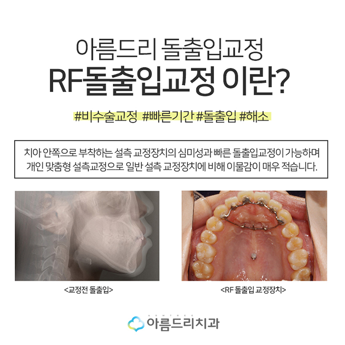 입툭튀교정 돌출앞니교정 도장쾅쾅 관련 이미지 5