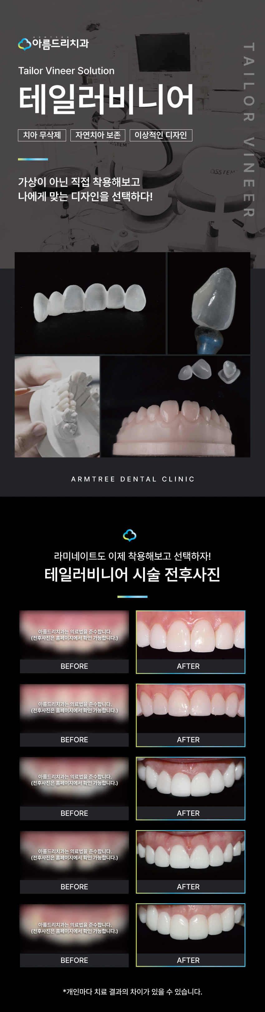 신논현역무삭제라미네이트 , 부작용 없이 예쁜 치아 가능할까? 관련 이미지 1