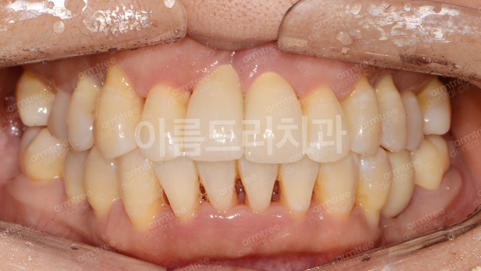 왜 임플란트와 치아교정을 다 잘아는 곳에서 치료해야할까?| 아름드리치과 진료일기 관련 이미지 7