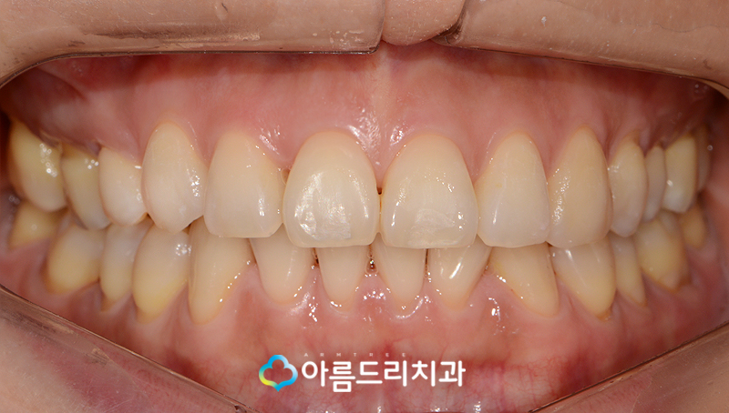 드라큘라이빨 송곳니교정 부분교정후기 관련 이미지 8