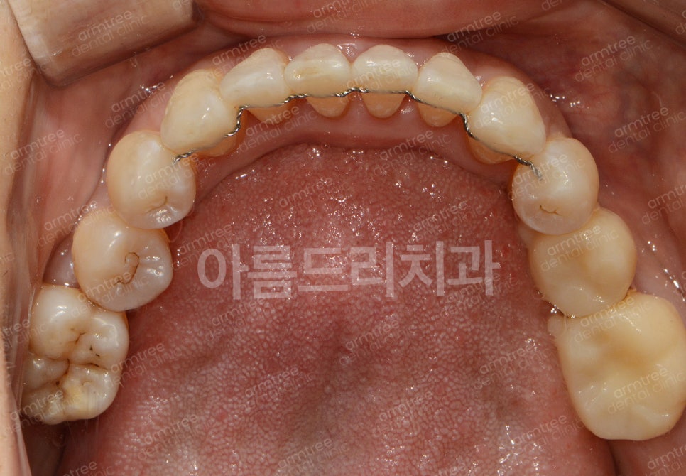 왜 임플란트와 치아교정을 다 잘아는 곳에서 치료해야할까?| 아름드리치과 진료일기 관련 이미지 5