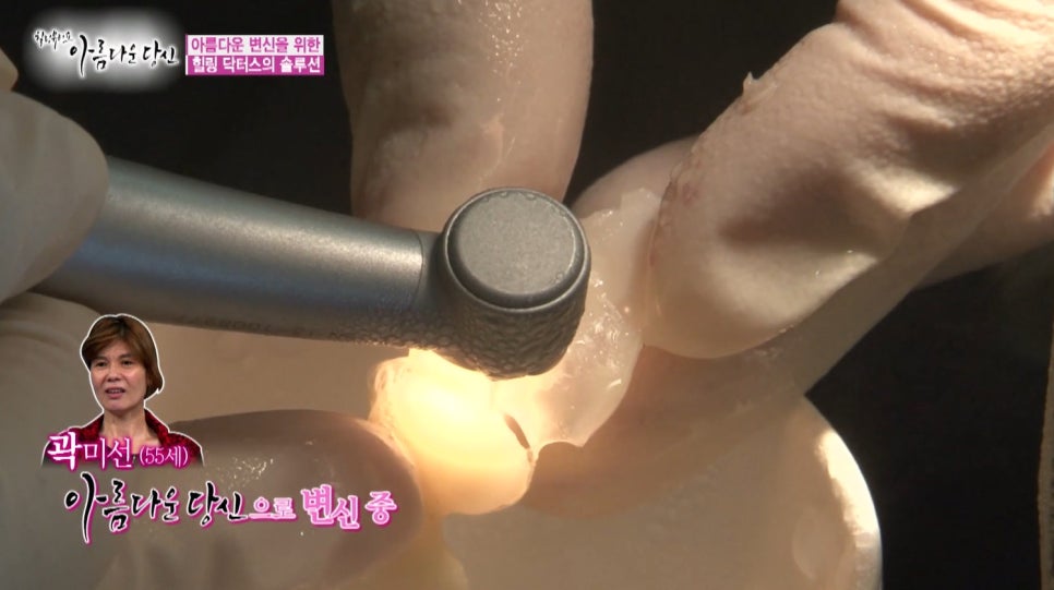 이현정원장의 아름다운 당신 시즌 1(4회 곽미선 도전자)신경치료, 심미보철, 보철치료, 올세라믹 관련 이미지 8