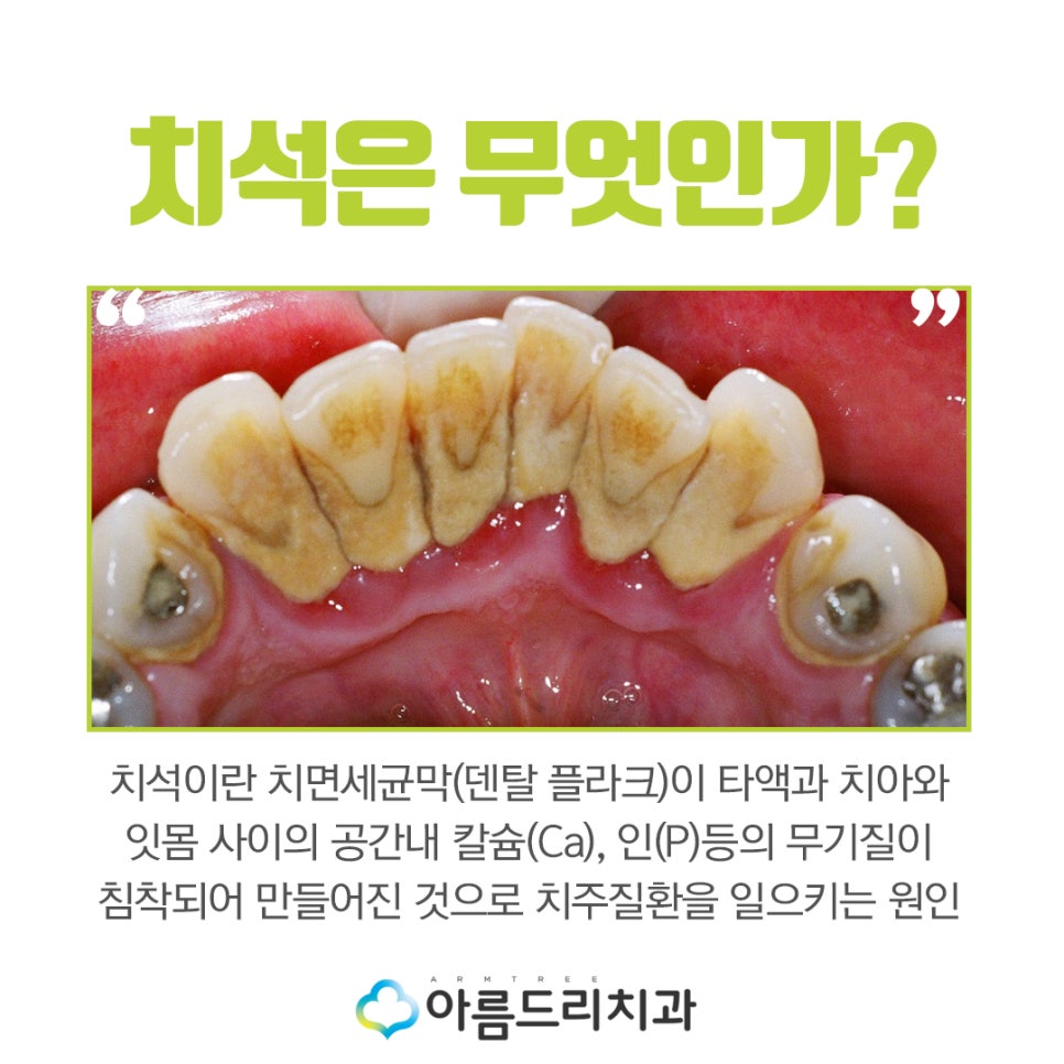 스케링가격(스켈링가격) 치과 스케일링 의료보험은? 관련 이미지 2
