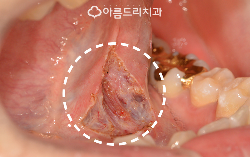 성인설소대수술 혀유착증 강남 바로알기 관련 이미지 8