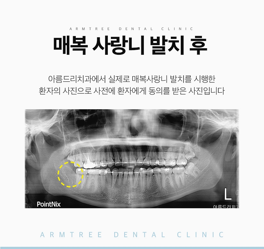 매복사랑니 발치후기통증 아름드리치과 관련 이미지 10
