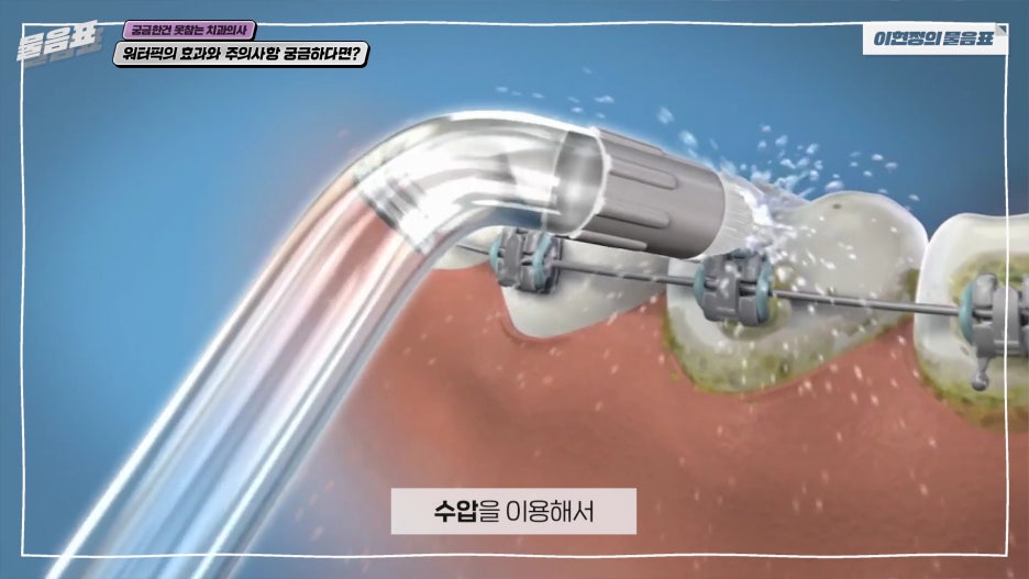 워터픽 효과와 효능 치아와 잇몸건강 #이현정의물음표 관련 이미지 9